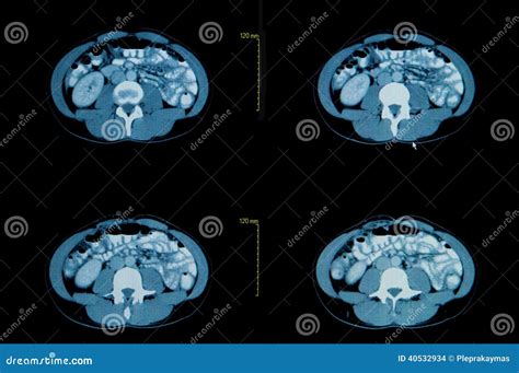 Computed Tomography of the Abdominal. Stock Photo - Image of cavity, healthcare: 40532934