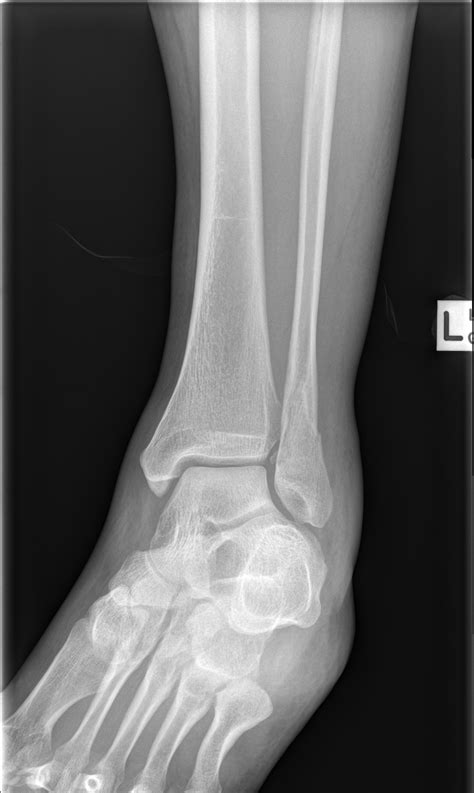 Fibula Distal