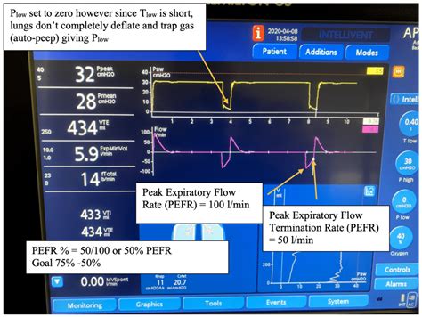 APRV Mode Explained 的图像结果