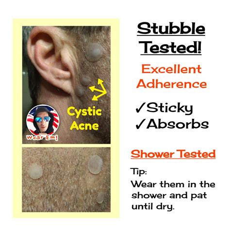 Buy 5pk [75] Acne Dots, Pimple Patches, [SMALL/LARGE SIZE] Cystic Acne ...