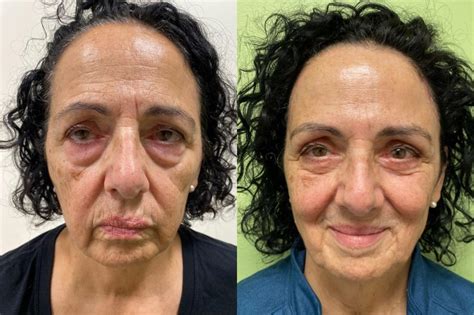 Brow Lift