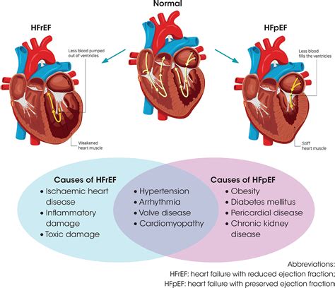 Heart failure in men - Singhal - 2021 - Trends in Urology & Men's ...