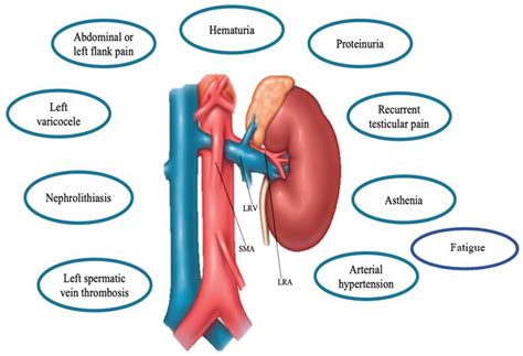 Renal Artery Nutcracker Syndrome at Michael Schiller blog