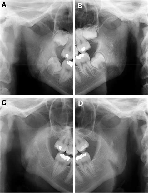 Idiopathic Condylar Resorption