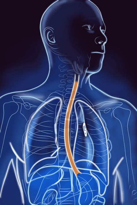Esophageal Stricture Dilation