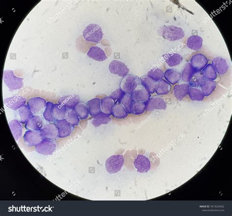 Blast Cells Peripheral Blood Smear: foto stock (editar agora) 1813535452