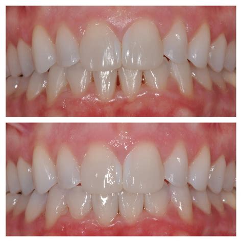 Image result for Bioclear Matrix System