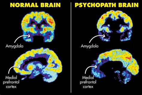 Understanding APD: Brain Scan Reveals Key Insights