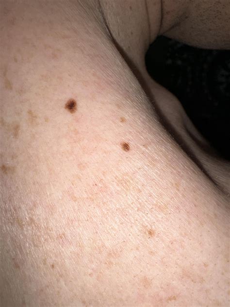 Atypical mole (?) : r/Melanoma
