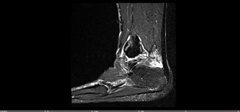 Insertional Achilles Calcific Tendonitis — Chicago Foot & Ankle ...