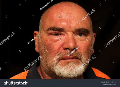 Swollen Face From Punch