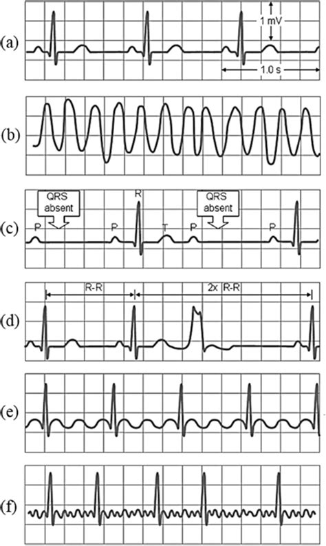Image result for ECG Examples