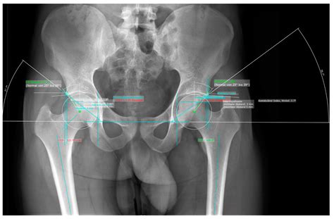 Young Female Pelvis X Ray Normal