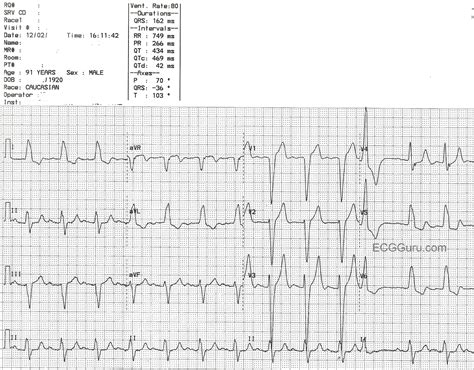 Image result for PVC Localization Chart