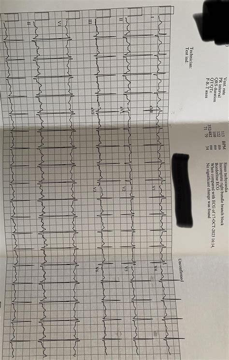 Prolonged qtc or normal? : r/ReadMyECG