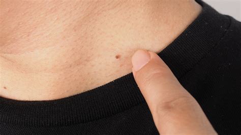 How Much Does Skin Tag Removal Cost? - GoodRx