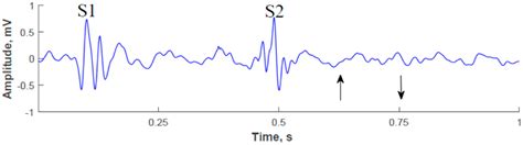Acoustic Detection of Coronary Occlusions before and after Stent ...
