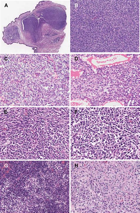 Recurrent MEIS1-NCOA2/1 fusions in a subset of low-grade spindle cell ...