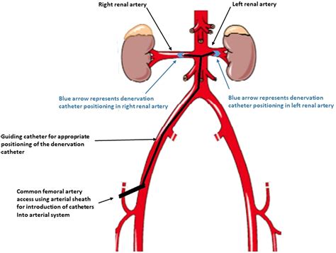 Renal Denervation Procedure