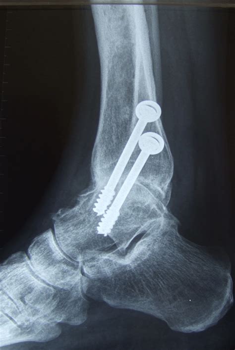 Ankle Arthritis Treatment | Total Ankle Replacement & Fusion | Mr ...