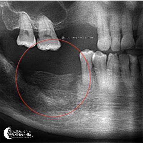 Osteoradionecrosis of the jaw – Dr. Néstor Heredia