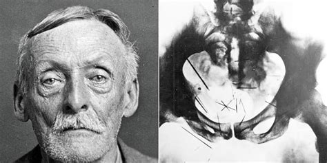 Albert Fish X Ray