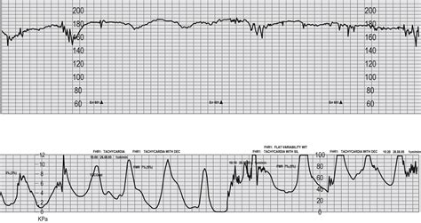 Fetal Surveillance in Labour - Clinical Tree