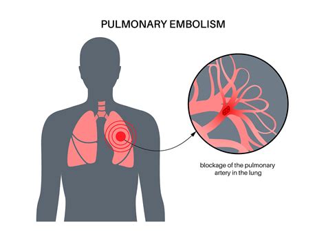 Pulmonary Embolism Diagram