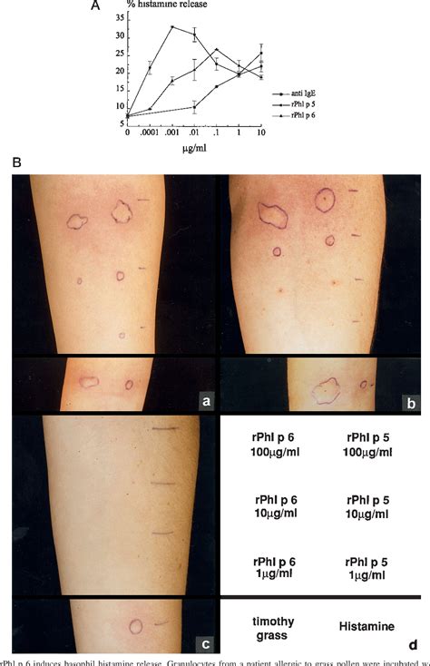 Timothy Grass Allergy