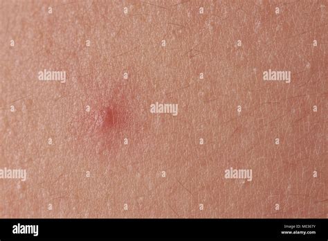 Image result for Blood Red Pimple