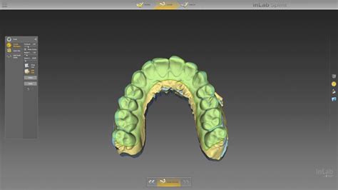 Image result for Inlab Splint Design