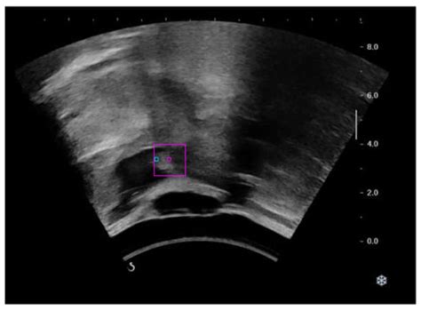 Automatic Hyoid Bone Tracking in Real-Time Ultrasound Swallowing Videos ...