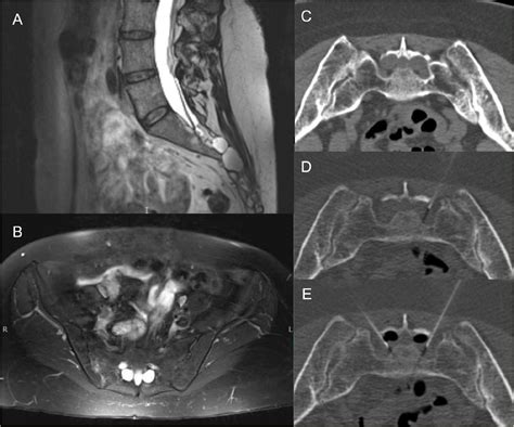Interventional approaches to symptomatic Tarlov cysts: a 15-year institutional experience ...