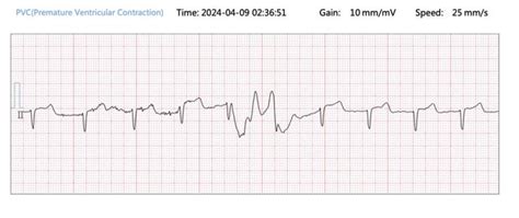 Image result for PVC ECG Reading
