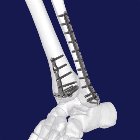 Compression Plate Ankle 的图像结果