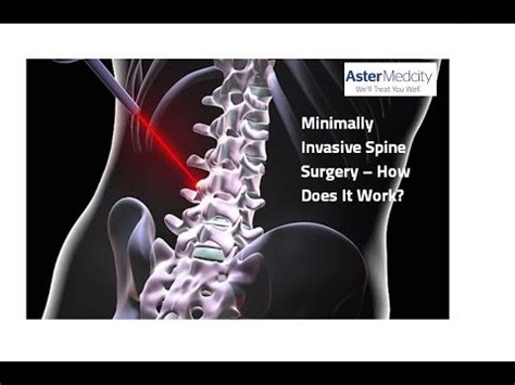 All About Scoliosis: Causes, Symptoms & Treatment | Aster Hospitals