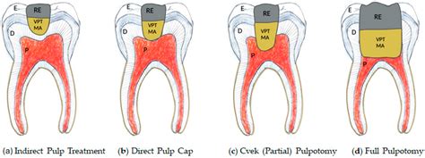 Innovations in Bioactive Materials for Dental Pulp Vitality Preservation in Children and Adolescents