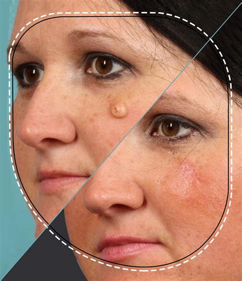 Image result for Sebaceous Cyst Removal Procedure