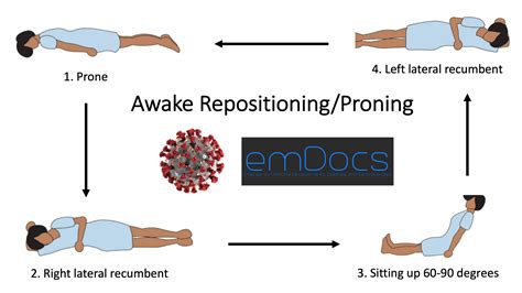 Prone Position Ventilation