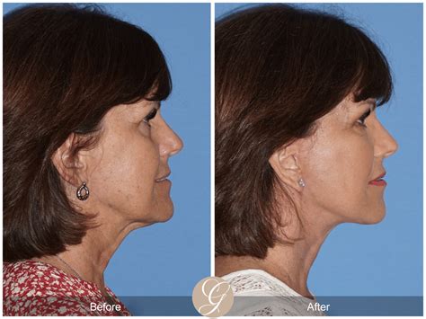 What is SMAS? Understand Your Facelift and Neck Lift Procedure