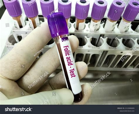 Folate Lab Test