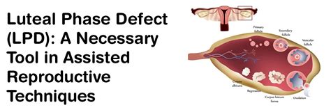 Luteal Phase Defect (LPD): A necessary tool in assisted reproductive ...