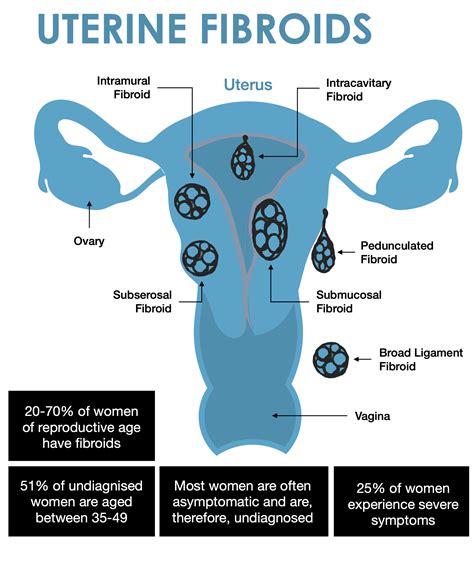 Uterine Fibroid Classification Fibroid Uterus: Causes, Symptoms,