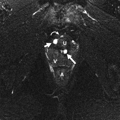 MRI Evaluation of Urethral Diverticula and Differential Diagnosis in Symptomatic Women | AJR