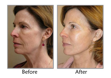 MACS Facelift (Mini Facelift) Salt Lake City, Utah | Utah Facial Plastics