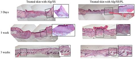 Growth Factors Delivery System for Skin Regeneration: An Advanced Wound ...