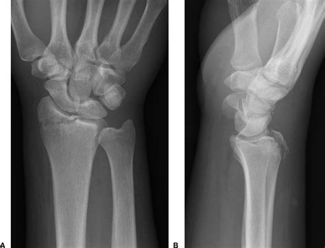 Radial Styloid Fractures - Journal of Hand Surgery