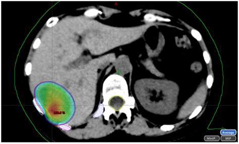 Limited Liver or Lung Colorectal Cancer Metastases. Systemic Treatment ...