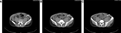 Image result for Appendicitis Left Side