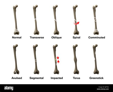 All Types of Bone Fractures Stock Photo - Alamy